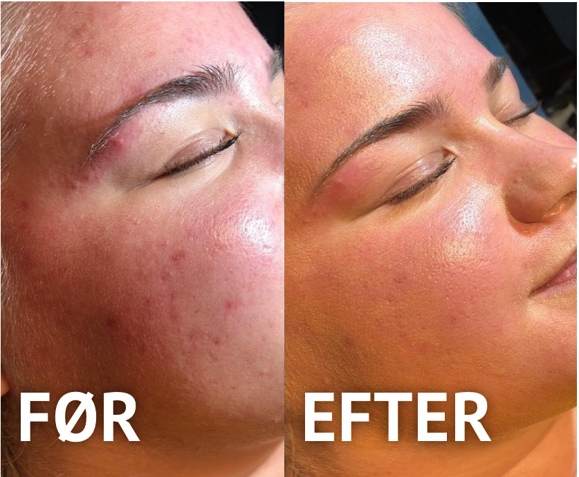 skinpen-image